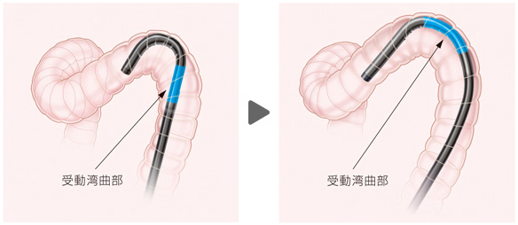 受動湾曲機構搭載大腸内視鏡スコープ