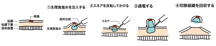 内視鏡的粘膜切除術
